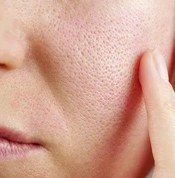 Open Pores